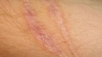 كيف أخفي علامات الجروح