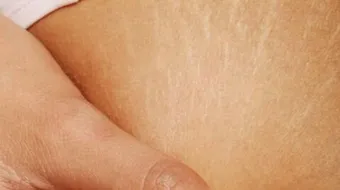 كيف أحافظ على بطني من تشققات الحمل