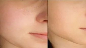 كيف أعرف نوع بشرتي وشعري