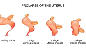 كيف أعرف هبوط الرحم