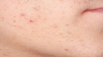 كيف أجعل بشرتي صافية من الحبوب