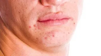 كيف أزيل حب الشباب من وجهي بسرعة