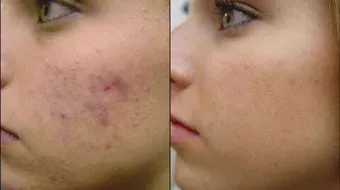 كيف أزيل حب الشباب وآثاره