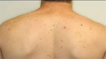 كيف ازيل حبوب الظهر