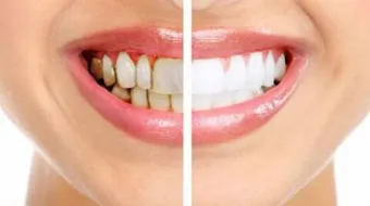 كيف أزيل جير الاسنان