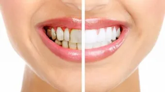 كيف ازيل جير الاسنان