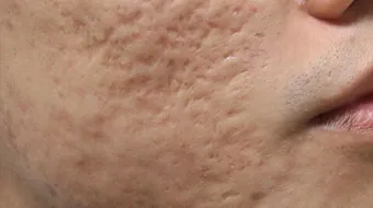 كيف ازيل حفر الوجه