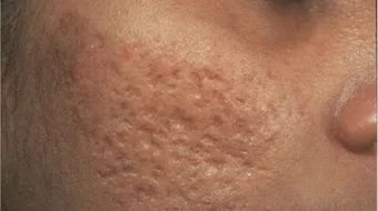 كيف أزيل الحب من وجهي