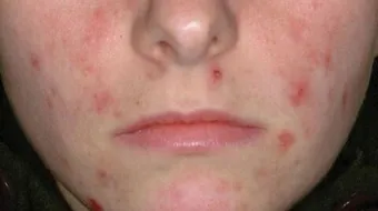 كيف أزيل الحبوب وآثارها