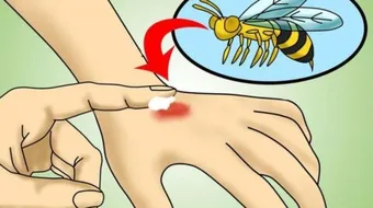 كيف أزيل آثار قرصة الناموس