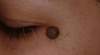 كيف أزيل حبة الخال طبيعياً