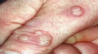 كيف أزيل الثالول