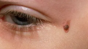 كيف أزيل الثآليل من الوجه