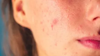 كيف أعالج حب الشباب في يوم واحد