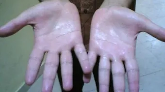 كيف أعالج تعرق اليدين