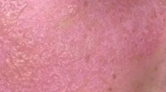 كيف أعالج وجهي من الحساسية