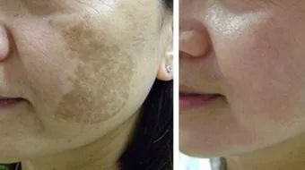 كيف أعالج بشرتي من الكلف