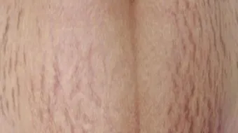 كيف أعالج كلف الحمل