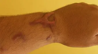 كيف أعالج آثار الحروق