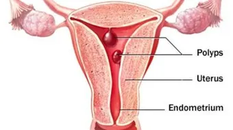 كيف نوقف النزيف الرحمي