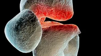 كيف نعالج مرض هشاشة العظام