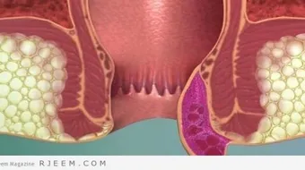 كيف تعرف أن لديك بواسير