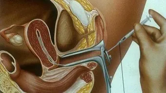 كيف يتم التلقيح الصناعي