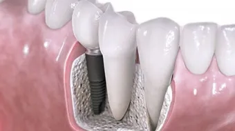 كيف تكون زراعة الاسنان