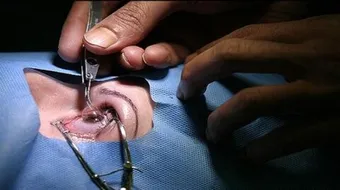 كيف تتم عملية الليزك للعيون