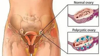 كيف يتم علاج تكيس المبايض