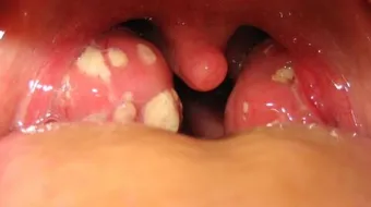 كيف يتم علاج التهاب اللوزتين