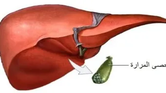 كيف تتكون الحصى في المرارة