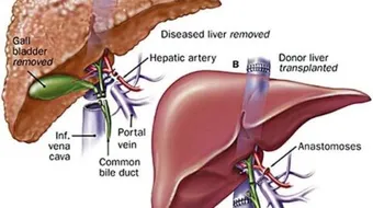 كيفية عملية زراعة الكبد