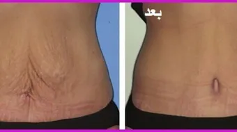 كيف أشد الجسم المترهل