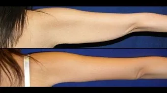 كيف أشد ترهلات الذراعين