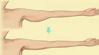 كيف أشد الترهلات