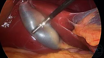 كيف يكون ألم المرارة