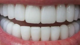 كيفية تنظيف الأسنان الصفراء