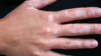 كيفية مكافحة البرص