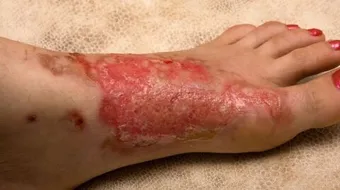 كيف تتعامل مع الحروق