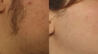 طريقة تأخير نمو شعر الجسم