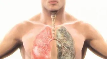 كيفية تشخيص سرطان الرئة