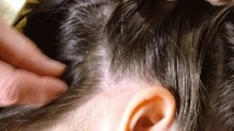 كيف اقضي على القمل