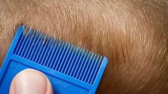 طريقة القضاء على القمل