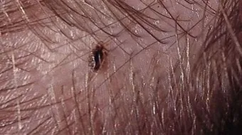 كيف أقضي على القمل نهائياً