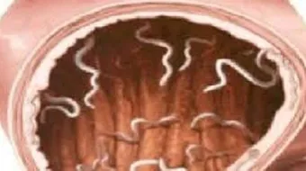 كيف أقضي على الديدان في البطن