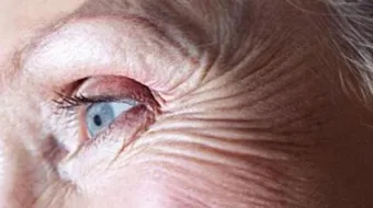 كيفية القضاء على التجاعيد