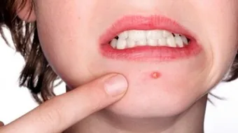 كيفية محاربة حب الشباب