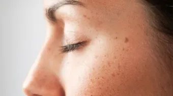 كيف تتخلص من حبة الخال