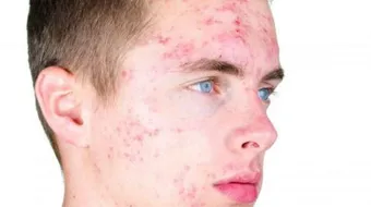 كيف يتم التخلص من حب الشباب